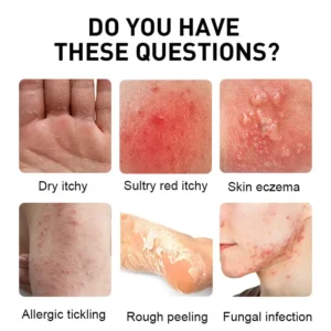 NESLEMY™ Psoriasis Cure Cream, relieves itching and restores smooth and youthful skin