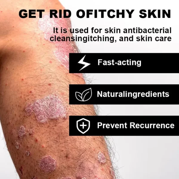 NESLEMY™ Psoriasis Cure Cream, relieves itching and restores smooth and youthful skin
