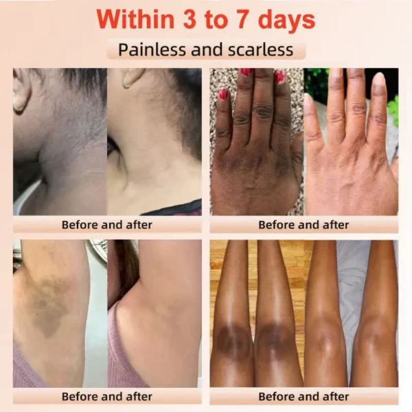NESLEMY™ Purifying Exfoliating Gel for Acanthosis Nigricans, Exfoliation, Dark Spots, Skin Tags, and Eczema